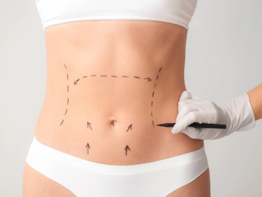 Avanços técnicos ajudam a reduzir cicatrizes cirúrgicas